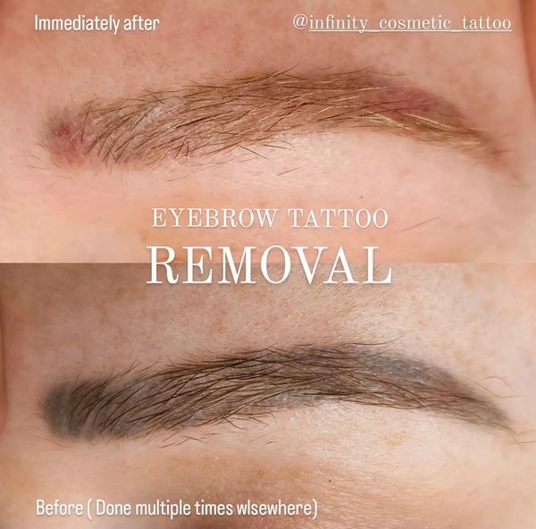 COSMETIC TATTOO REMOVAL Infinity Cosmetic Tattoo